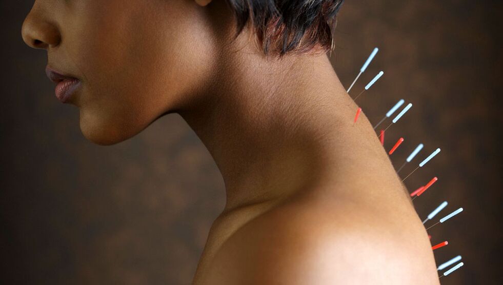 Acupuncture avec ostéochondrose cervicale