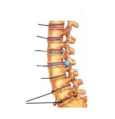 Comment se développe l'ostéochondrose