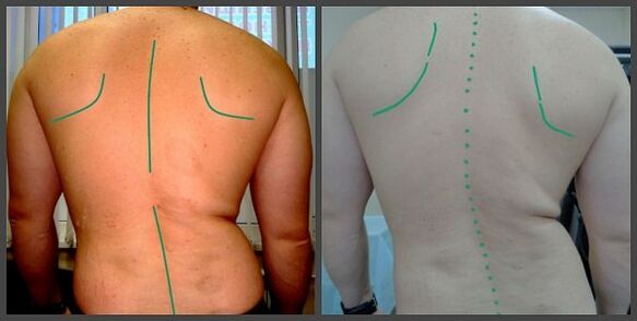 Craumatique de la colonne vertébrale avec une ostéochondrose