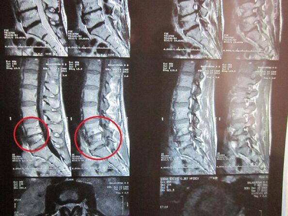 Diagnostic de l'ostéochondose cervicale