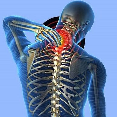 Douleur au cou avec ostéochondrose cervicale