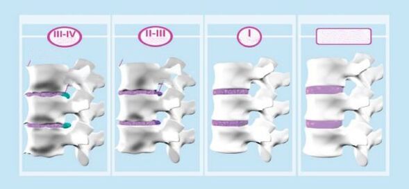Stades d'ostéochondrose cervicale