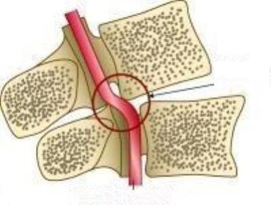 Syndrome des artères de Vail