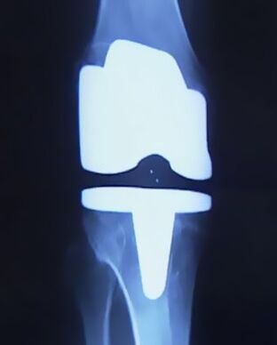 Image x-ray du genou avec une prothèse artificielle après l'opération pour changer l'articulation