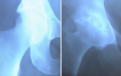 Mousse d'arthrose de l'articulation du genou