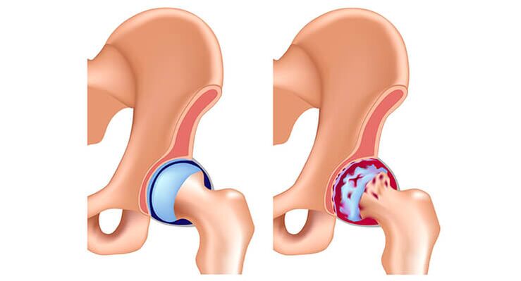 articulation de la hanche saine affectée par l'arthrose