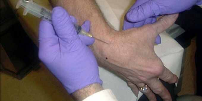 Ponction pour douleur dans les articulations des doigts