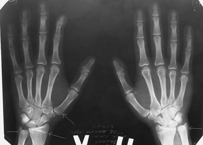 Radiographie pour douleur dans les articulations des doigts