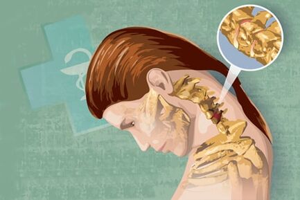 Symptômes réflexes de l'ostéochondrose